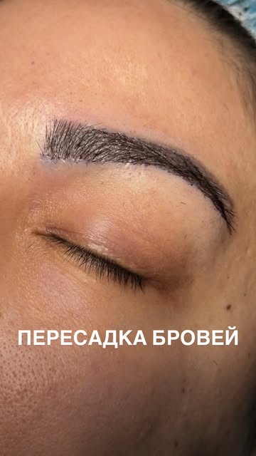Как много на самом деле решают брови ✨

Пересадка позволяет изменить форму, добавить густоты и созда