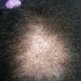 🌿 Healthy Hair Starts at the Scalp

If you're experiencing thinning hair, excessive shedding, or an