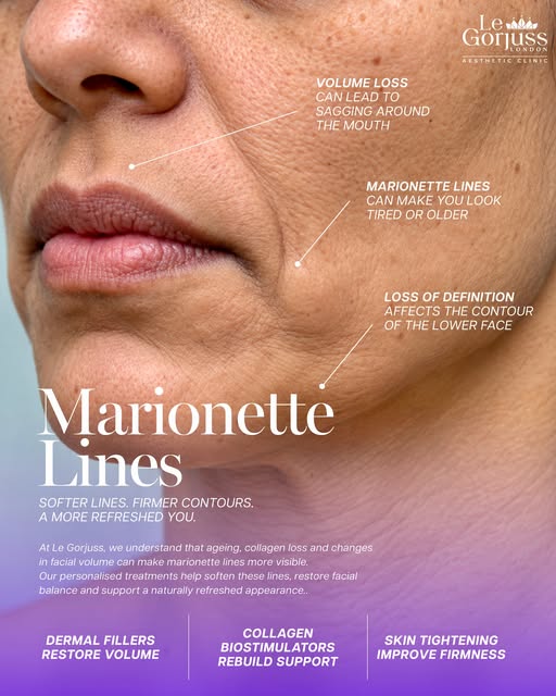 Marionette lines can subtly change the way the lower face looks — but the goal isn’t to change your 