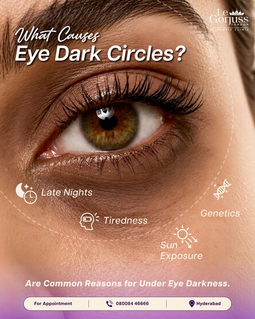 dark circles can be caused by more than just lack of sleep. genetics, late nights, tiredness, and su