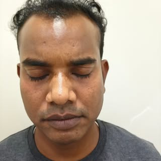 ✨ REAL HAIR. REAL CONFIDENCE. REAL RESULT

From hair loss to a natural-looking hairline—this transfo