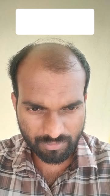 Second hair transplant. Natural looking results. Realistic results. #hairtransplant #whitefield #der