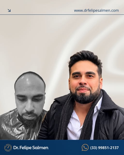 Neste caso, conseguimos reconstruir a linha frontal e devolver densidade ao cabelo, mantendo um dese