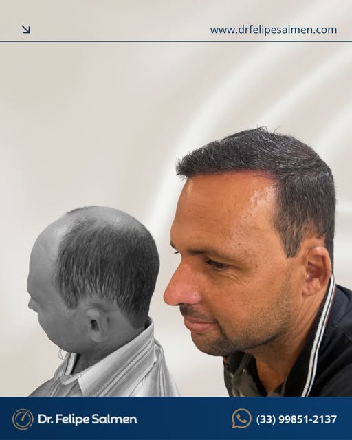 Neste caso, conseguimos observar uma mudança significativa na região frontal e superior, com reconst