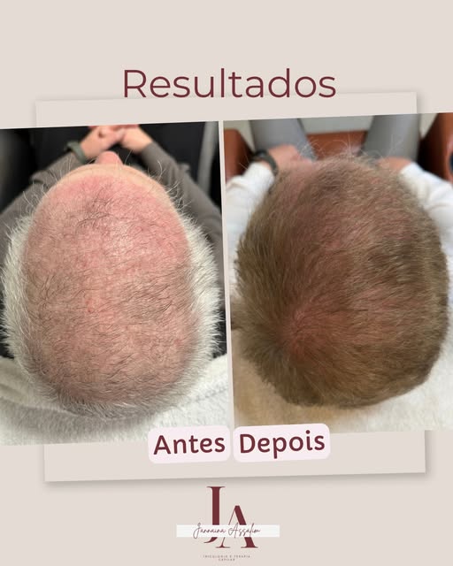 ACOMPANHAMENTO PÓS TRANSPLANTE 

Esse paciente fez transplante capilar em Bauru, e desde a alta dele