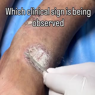 Kabhi dekha hai ki Psoriasis ki scaling ko gently scrape karne par chote-chote blood spots kyu aate 