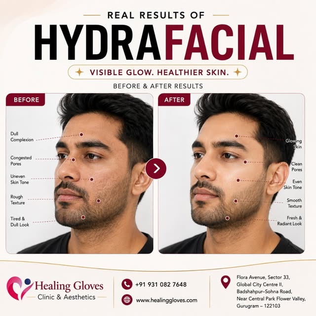 ✨ HydraFacial Results for Men — Because Great Skin Isn’t Just for Women!

Dull complexion, clogged p