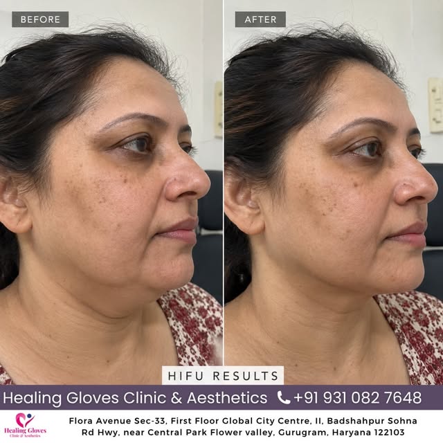 ✨ HIFU Face Lift Results — Natural Definition, No Surgery ✨

See the difference with HIFU skin tight