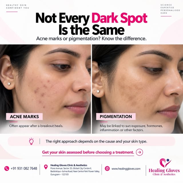 ✨ Not Every Dark Spot Is the Same — Acne Marks or Pigmentation? ✨

Those dark spots on your face may