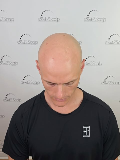 (Just raw photos pre & post session 3 & healed) 
The opportunity to have a choice in how you look an