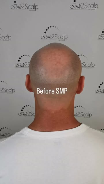 I HATE THE BALD CROWN… (here is just some raw video… pre & post session 3 & healed) 
The opportunity