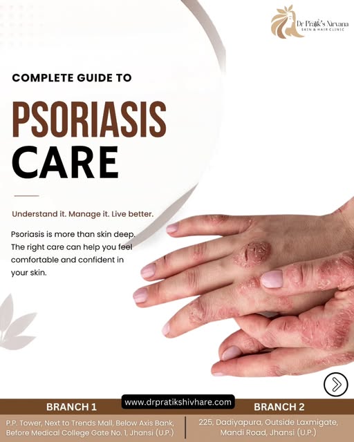 Psoriasis is more than just a skin condition—it can affect your comfort, confidence, and everyday li