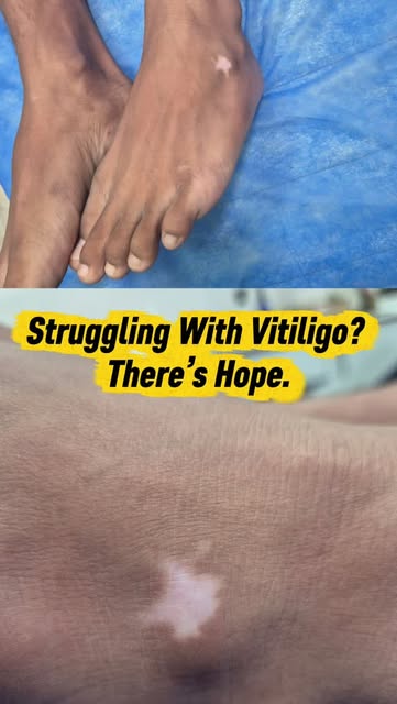 Struggling With Vitiligo? There’s Hope. ✨

Worried about white patches or changes in your skin?
With