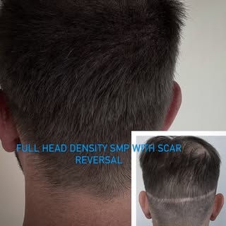 The combination of Scar reversal, full head density and the perfect haircut can really give you life