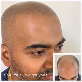 Natural looking results are a top priority for me. I love a soft broken hairline with a perfect colo