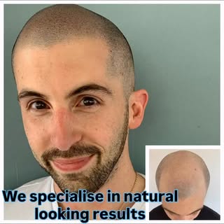 SMP is a modern option for dealing with hair loss and thinning. Please call us for a free in person 