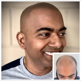Reclaim your Hairline along with your confidence. Scalp micropigmentation is a permanent non-surgica