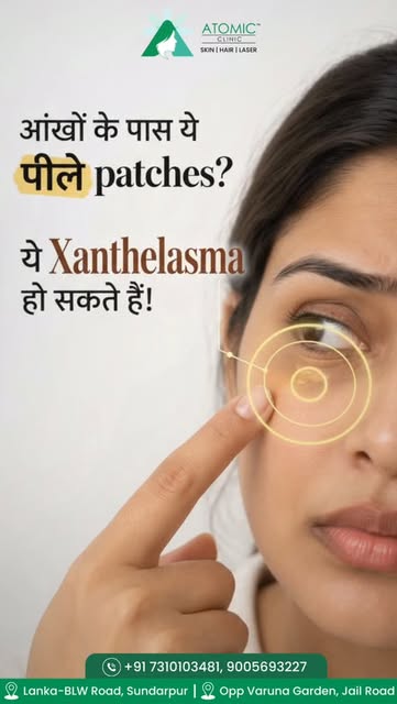 Those yellow patches around the eyes? 👀
Don’t hide them. Get them evaluated and treated.

✨ Xanthel