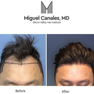 Natural, dense results are possible with a single session with the expertise of Dr Miguel Canales at
