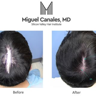 Hair transplants can be used to restore hair growth on scar tissue, effectively camouflaging or even