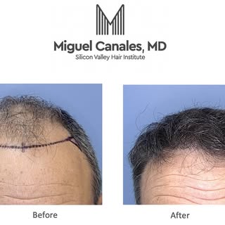 What can a new natural hairline do for you ?  Regain confidence ? Look 10 years younger ?  Explore y