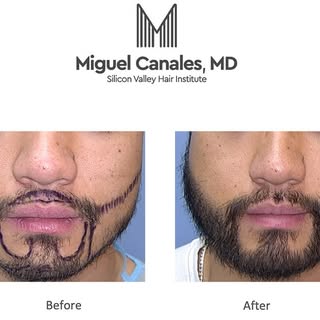 Natural beard transplants can give you the beard you’ve always wanted. Results are permanent and it’