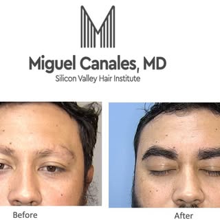 Eyebrow transplants reframe the face and give facial expressions their character. Explore your optio