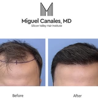 Dr Canales: Are you happy you did the hair transplant ? Patient: “It was the best money I ever spent