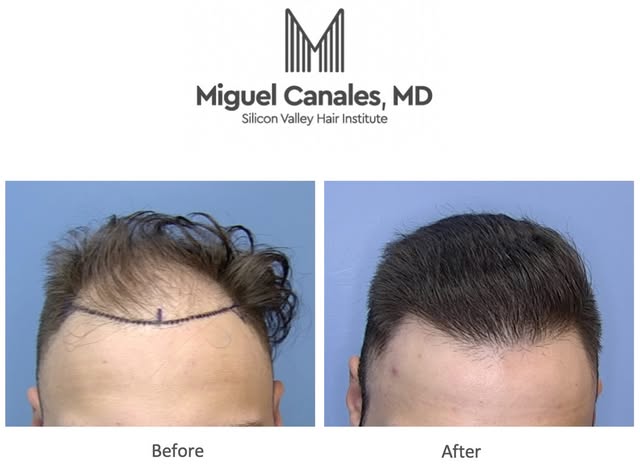 Your natural hair , natural results.  Feel confident again .  Explore your hair transplant options b
