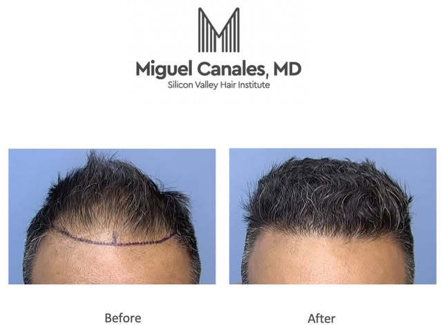6 months after hair transplantation  this patient expressed happiness for his natural looking hairli