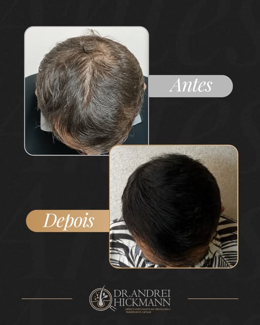 A repartição alargada é um dos sinais mais silenciosos da calvície. O cabelo perde densidade devagar