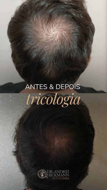 Boa parte das pessoas que me procura acha que só existe um caminho para recuperar cabelo, e que esse