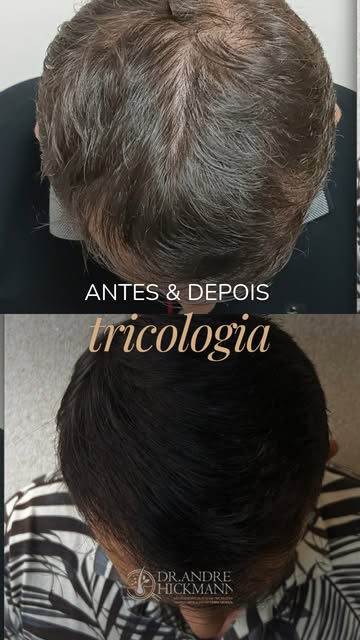 Tratamento capilar clínico não tem resultado em semanas. O ciclo do fio é lento, e qualquer mudança 