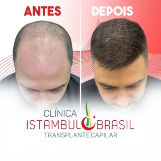 Transplante capilar - Clínica Istambul Brasil💪🏼😍

O resultado fala por si! 💪🏼😍 Com a técnica F
