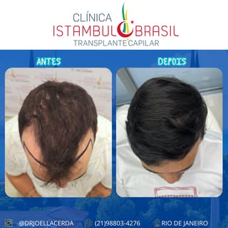 Transplante Capilar - Clínica Istambul Brasil 💪🏼😍

Agende sua avaliação agora mesmo! 📲

📞 (21) 