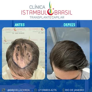 Transplante Capilar - Clínica Istambul Brasil 💪🏼😍

Agende sua avaliação agora mesmo! 📲

📞 (21) 