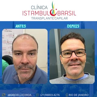 Transplante Capilar - Clínica Istambul Brasil 💪🏼😍

Agende sua avaliação agora mesmo! 📲

📞 (21) 