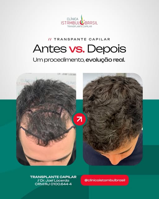 Resultados reais você encontra aqui na @clinicaistambulbrasil 🚀

🔗 Quer avaliar o seu caso? Link n