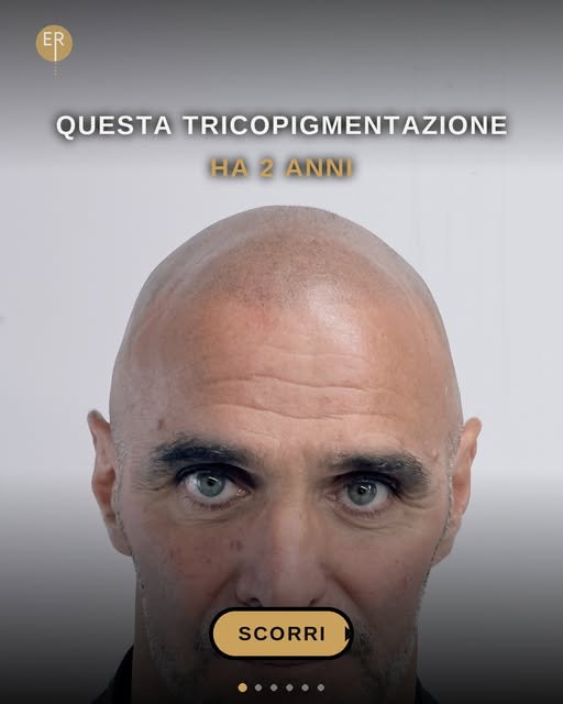 ✨ Questa tricopigmentazione ha 2 anni.
👉 Scorri per vedere com'era prima, alla fine della terza sed
