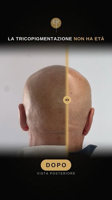 ✨ La tricopigmentazione non ha età.
Guarda il risultato di questo cliente 👀

💬 Consulenza gratuita