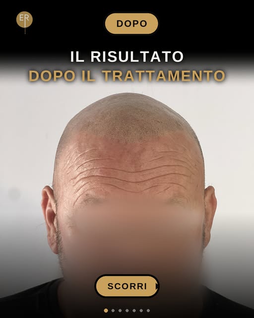 👀 Prima e dopo. Scorri per vedere com'era.

🎯 Il Metodo ER: micropuntino, distribuzione e giusta t