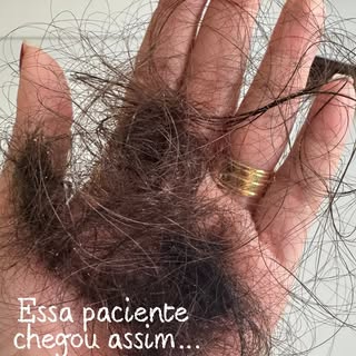 Me conta se essa sensação de ver uma queda de cabelo indo embora não é a melhor? Paciente extremamen