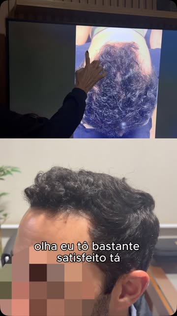 ⏳ Tempo é cabelo!

Os resultados aparecem quando existe constância e acompanhamento médico.
Esse é o