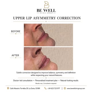 Subtle correction, beautifully balanced. ✨

Upper lip asymmetry correction designed to enhance symme