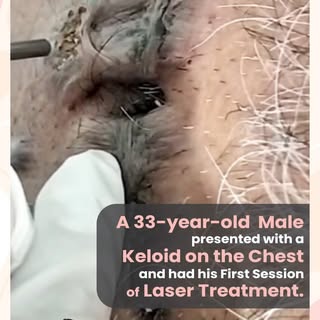Step into the inspiring journey of a resilient 33-year-old as he begins his transformative keloid tr