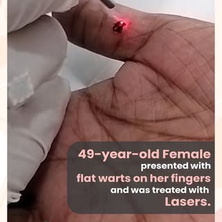 Say Goodbye to Flat Warts and Hello to Smooth Skin with Laser Treatment!

Our latest success story f