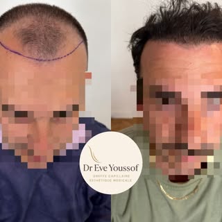 Une ligne frontale redessinée et masculine.
Un résultat naturel conçu pour durer dans le temps.

Voi