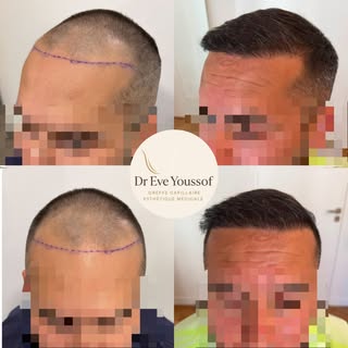 ➡️ Nous avons redessiné la ligne frontale de notre patient, voici ses premiers résultats à 6 mois po