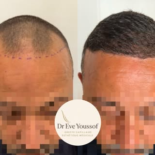➡️ Reconstruction de la ligne frontale de notre patient à 6 mois post greffe capillaire avec la tech
