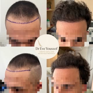 ➡️ Reconstruction de la ligne frontale de notre patient à 6 mois post greffe capillaire. 

✔️Techniq